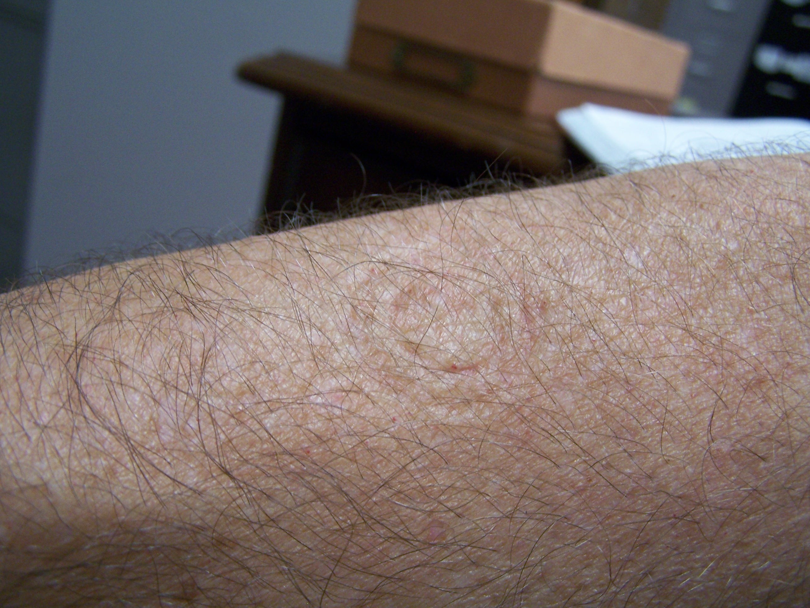 Figure 4. Bed bug feeding site on arm after feeding (rings are from ...