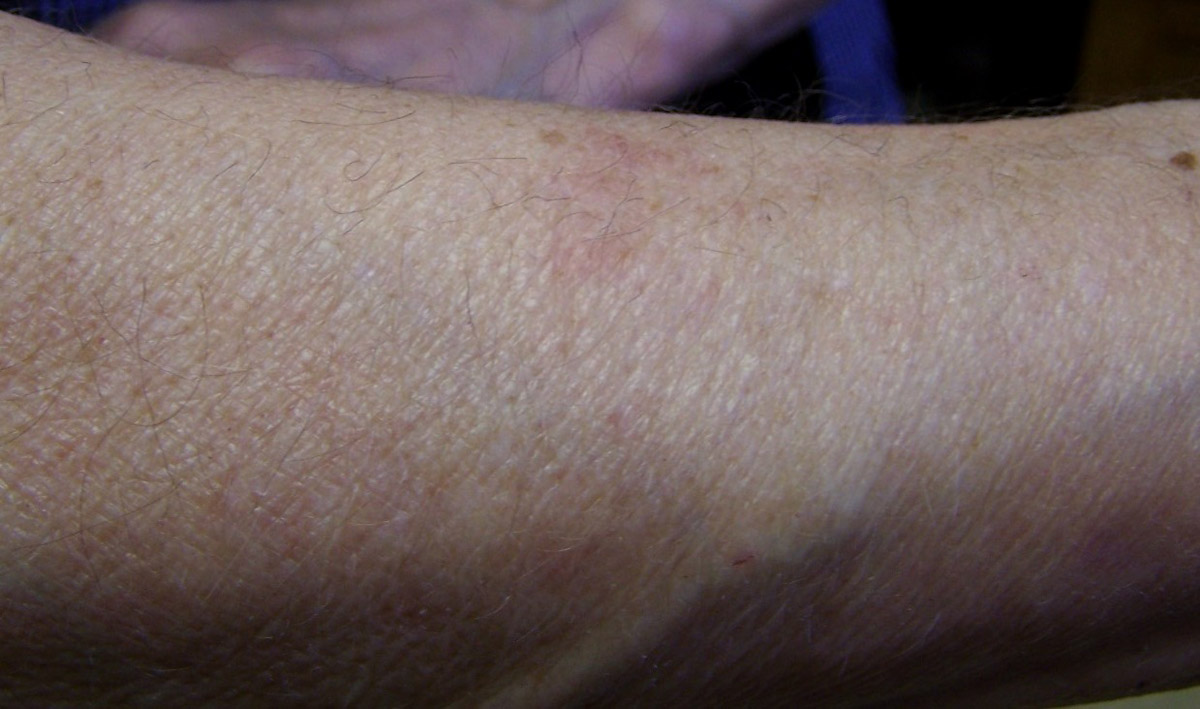 Bed Bugs Rash Arms Right arm, hyperpigmentation